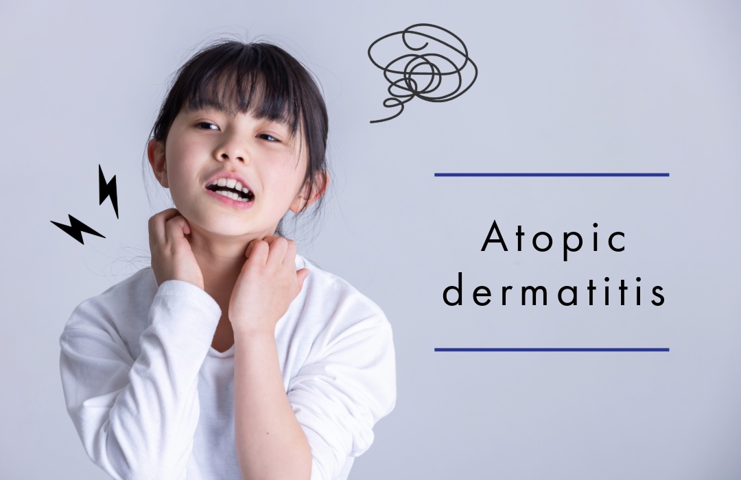子供のアトピー性皮膚炎